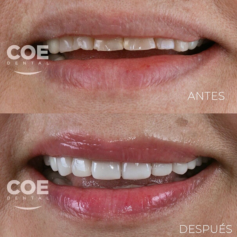 antes-despues-05