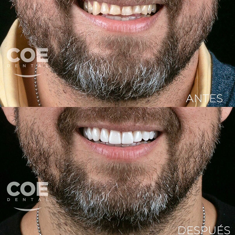 antes-despues-14