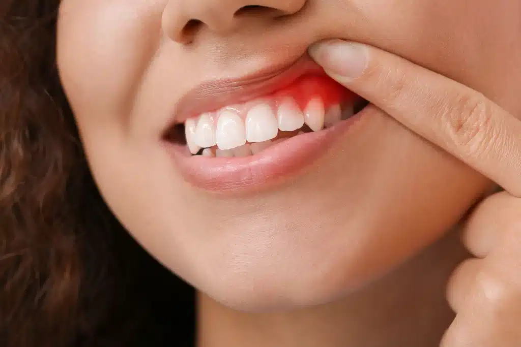 Encías inflamadas por gingivitis