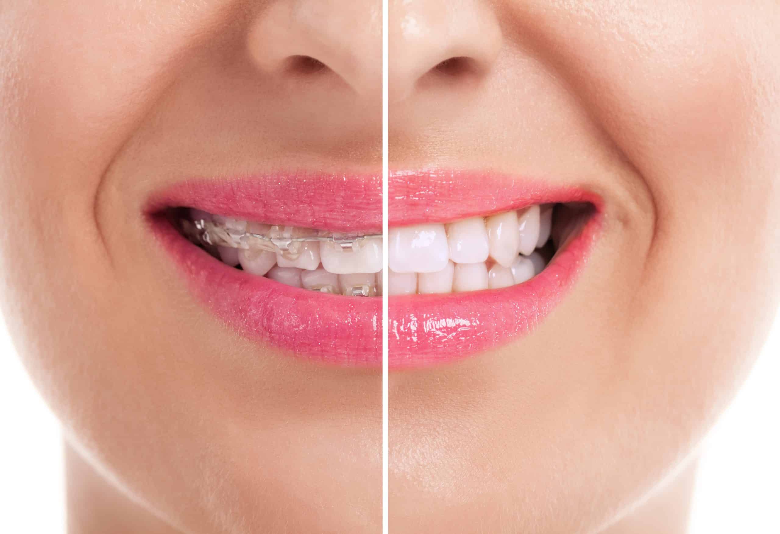 Antes y después de una ortodoncia dental.
