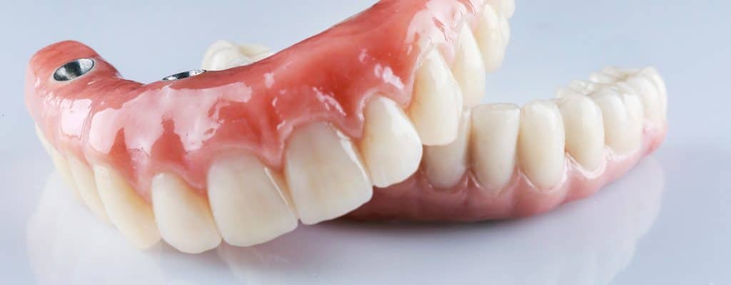 Ejemplo de prótesis dentales.