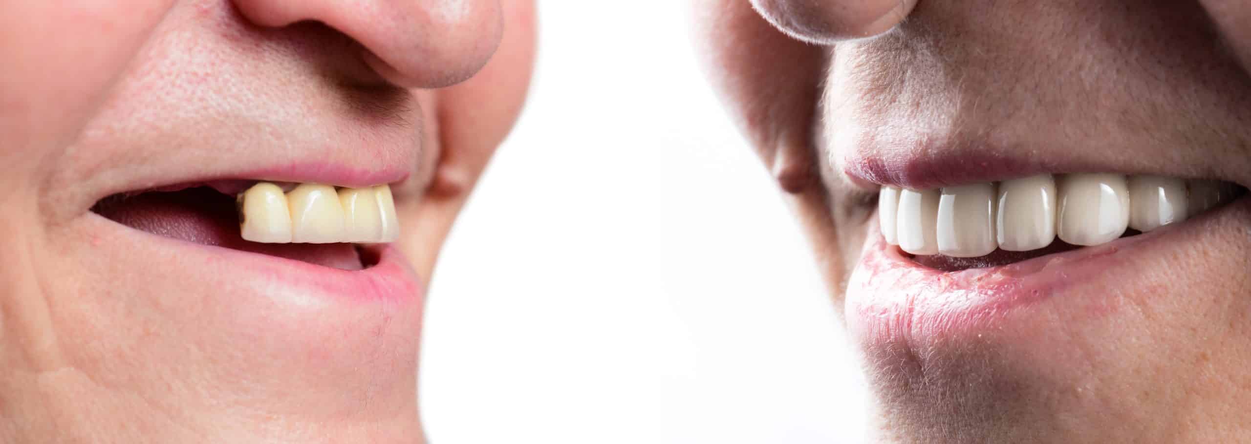 Antes y después de colocarse unas prótesis dentales.