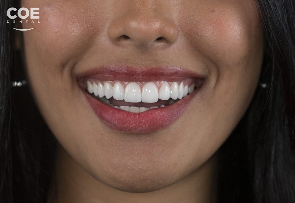 Carillas de porcelana COE Dental