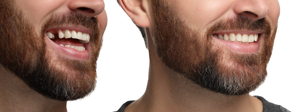 te presentamos 5 razones clave que demuestran las ventajas de los implantes dentales. Sigue leyendo y descubre cómo los implantes dentales pueden cambiar tu calidad de vida