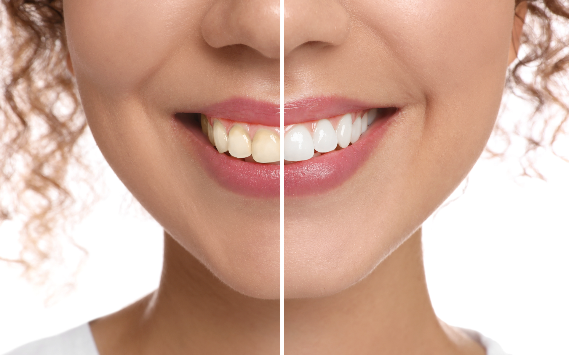 Antes y después de un blanqueamiento dental.