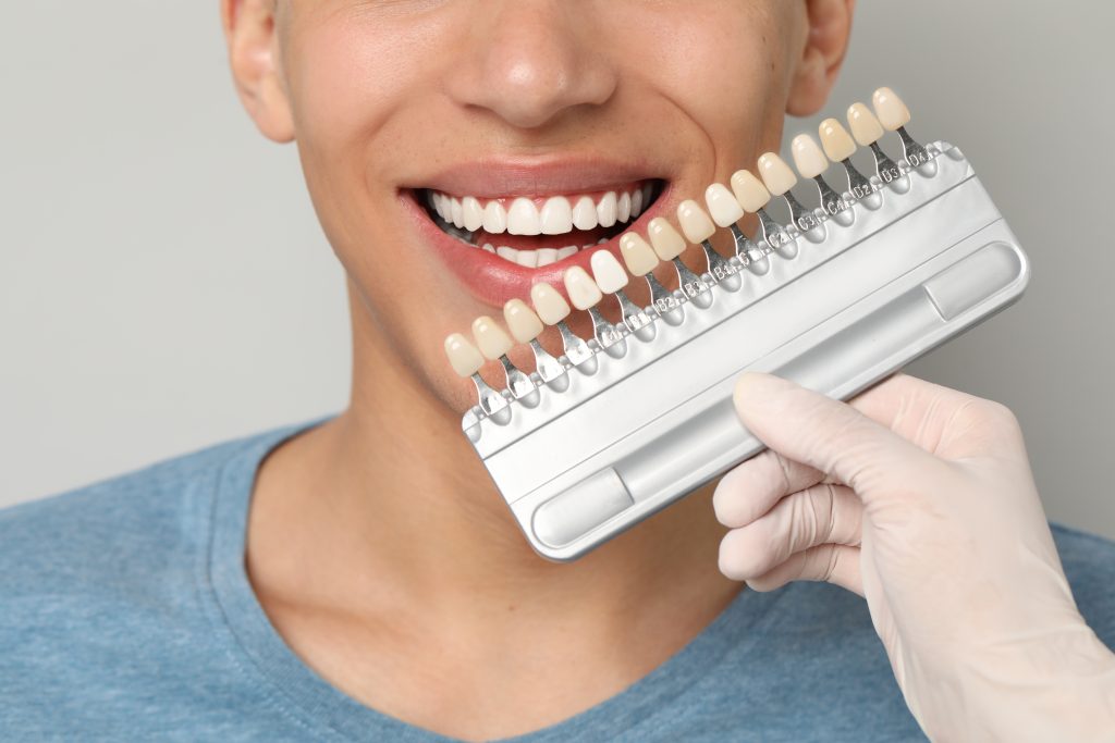 diferencia entre carillas de porcelana y resina