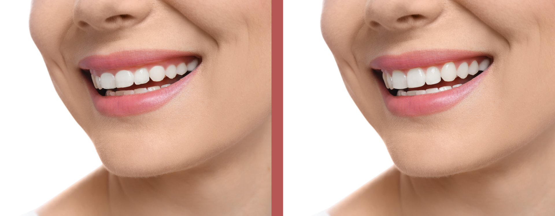 Mujer con sonrisa antes y después de una gingivoplastia.