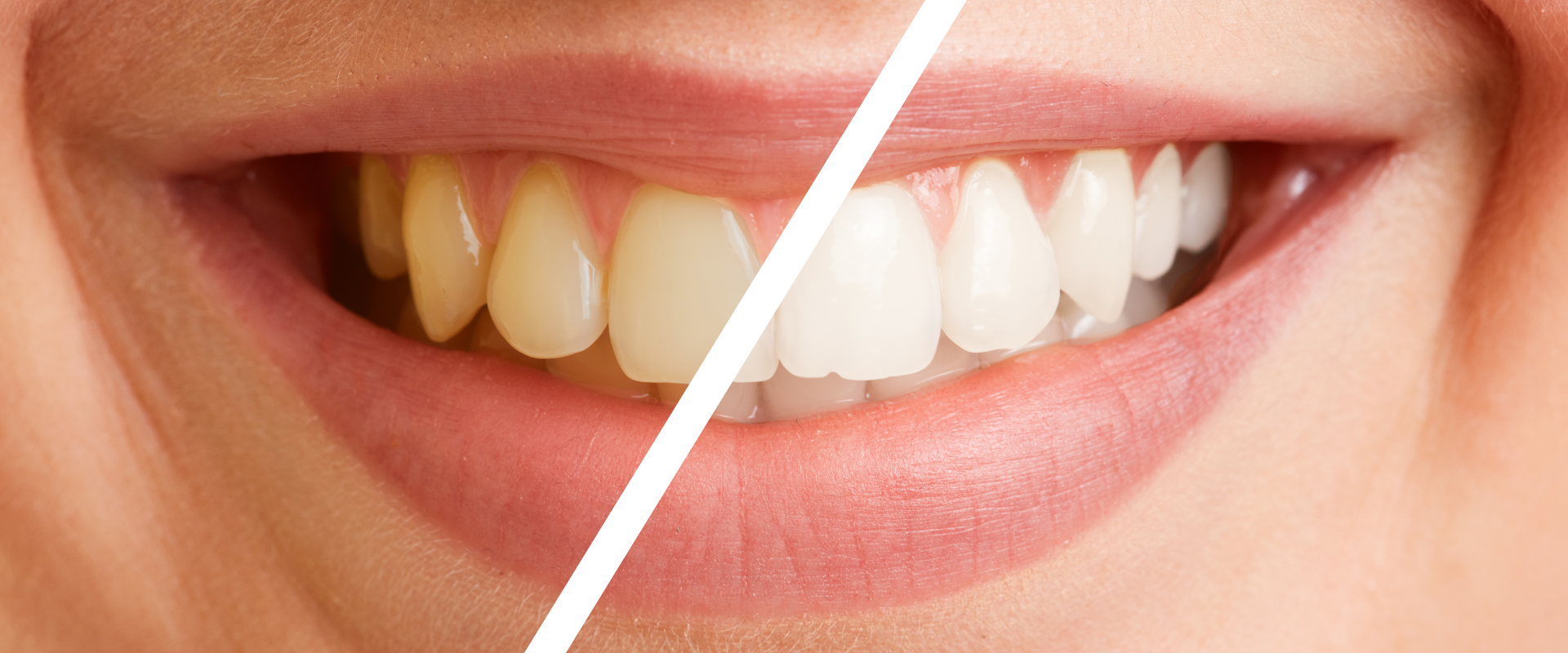 Sonrisa antes y después de una profilaxis dental.