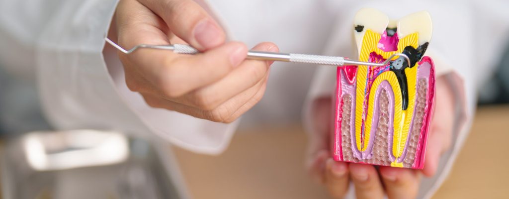 En este artículo, aprenderemos a qué llamamos dientes picados: cómo son y cuáles son sus causas.