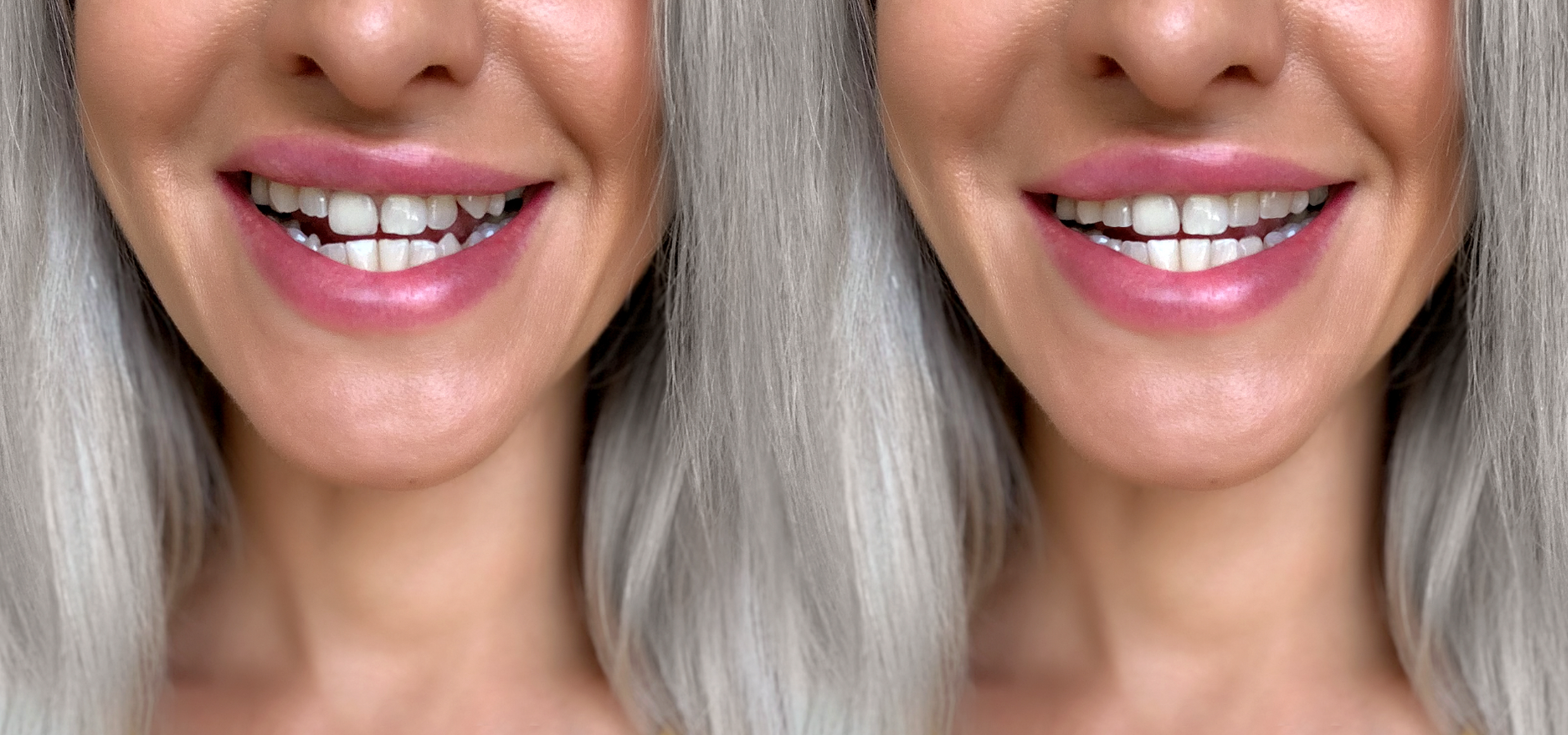 Antes y después de corregir unos dientes chuecos.