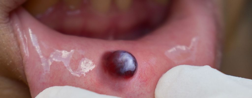 En este artículo aprenderemos sobre el mucocele: qué es, sus síntomas, causas y los tipos que existen.