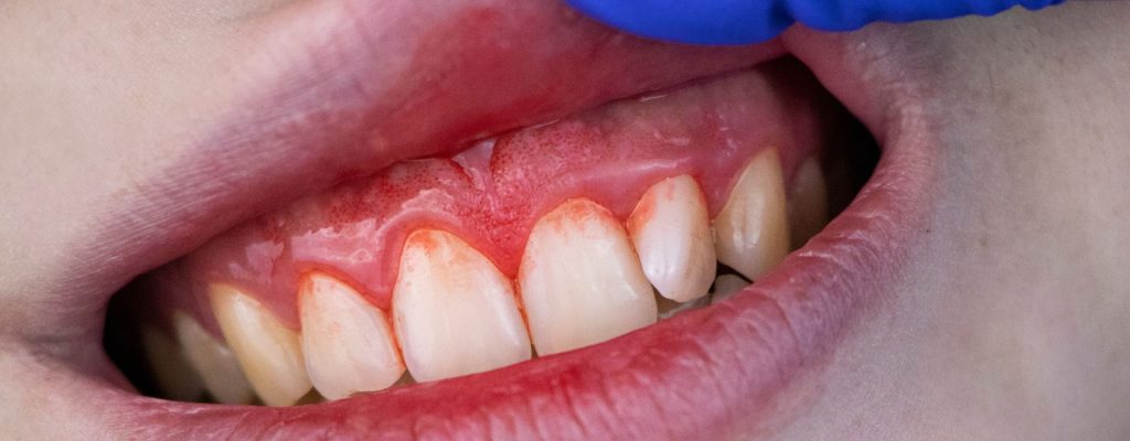 En este artículo aprenderemos sobre la periodontitis: qué es, sus síntomas, causas, cómo diagnosticarla y los tipos que existen.