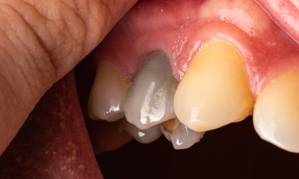 ¿Qué es la necrosis pulpar y cómo podemos tratarla?