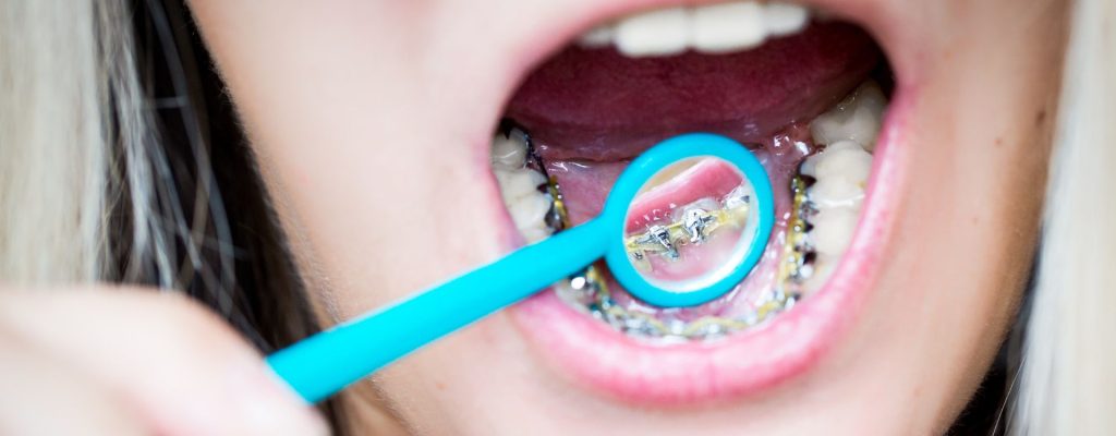 En este artículo conoceremos los Brackets invisibles: en qué consisten, cómo funcionan, los diferentes tipos que existen y las ventajas que ofrecen a quienes optan por ellos.