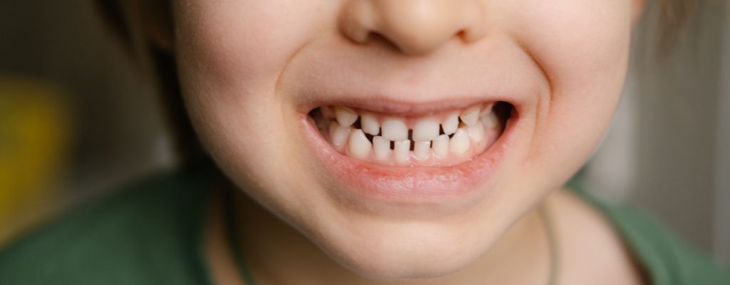 En este artículo aprenderemos sobre los dientes separados: por qué ocurren, cuáles son los problemas que podría ocasionar, los tipos que existen y los tratamientos más comunes para este problema.