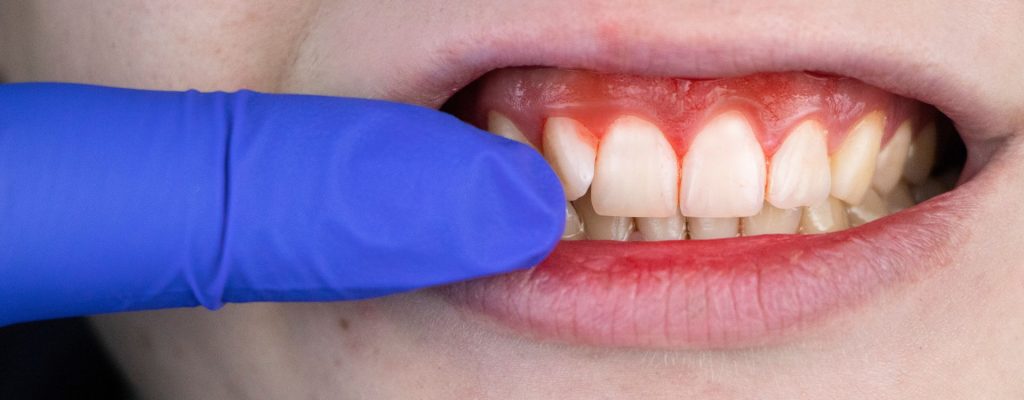 Conoce las principales enfermedades periodontales.