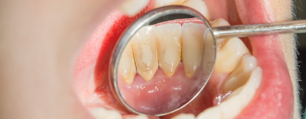 Conoce todo sobre la placa bacteriana y cómo combatirla.