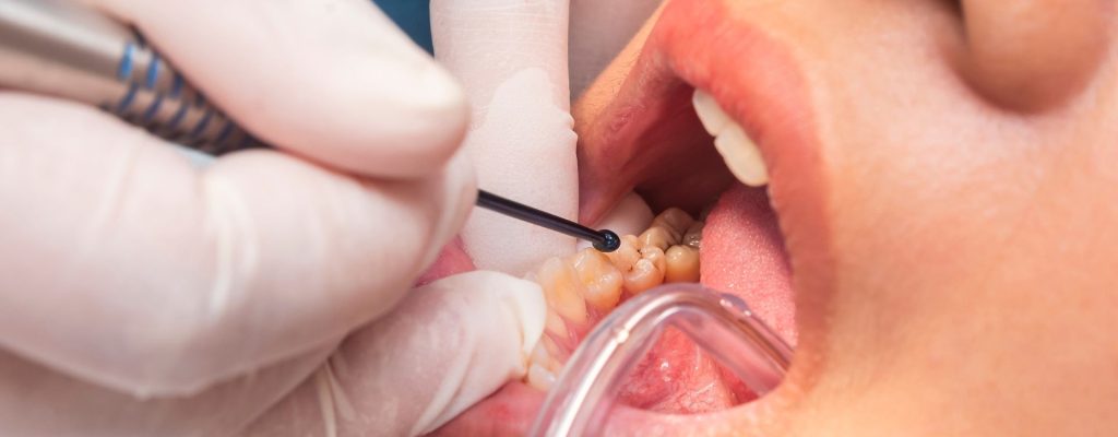En este artículo aprenderemos sobre la resina dental: qué es, para qué sirve, sus tipos y cuáles son sus propiedades para la salud bucal.