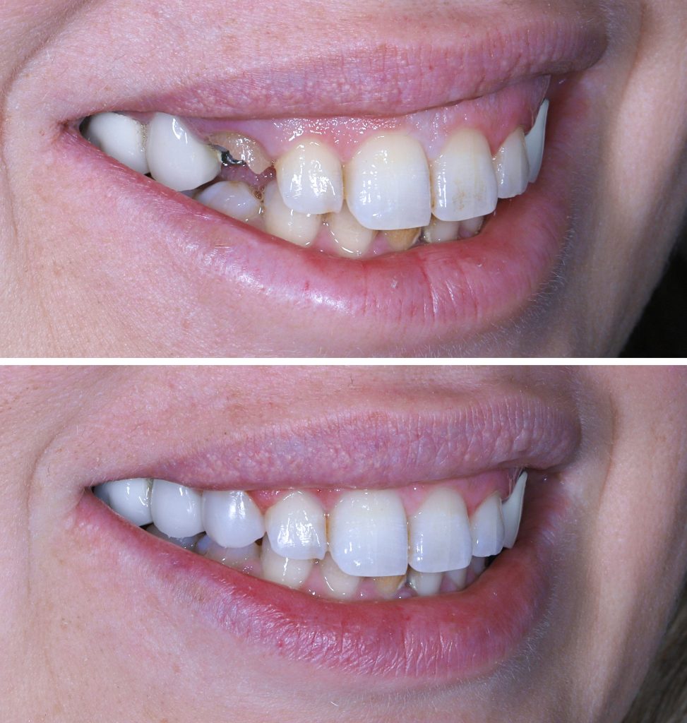 Aplicación de resina dental: antes y después.