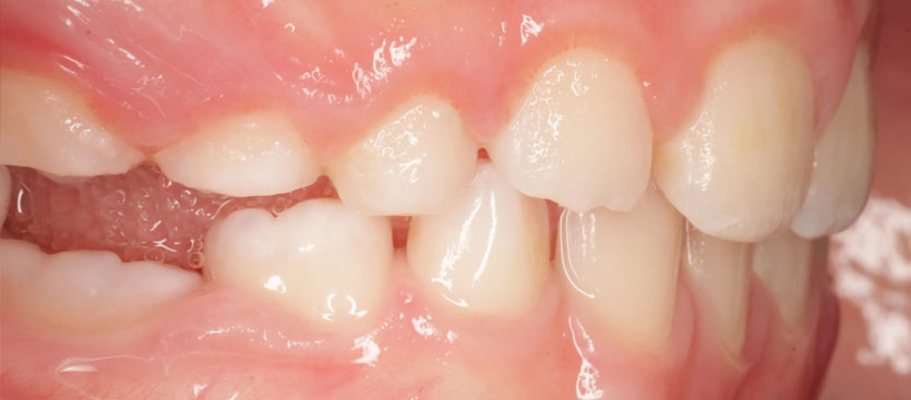 Anquilosis dental