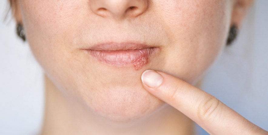 Herpes labial (VHS-1): síntomas, causas y prevención