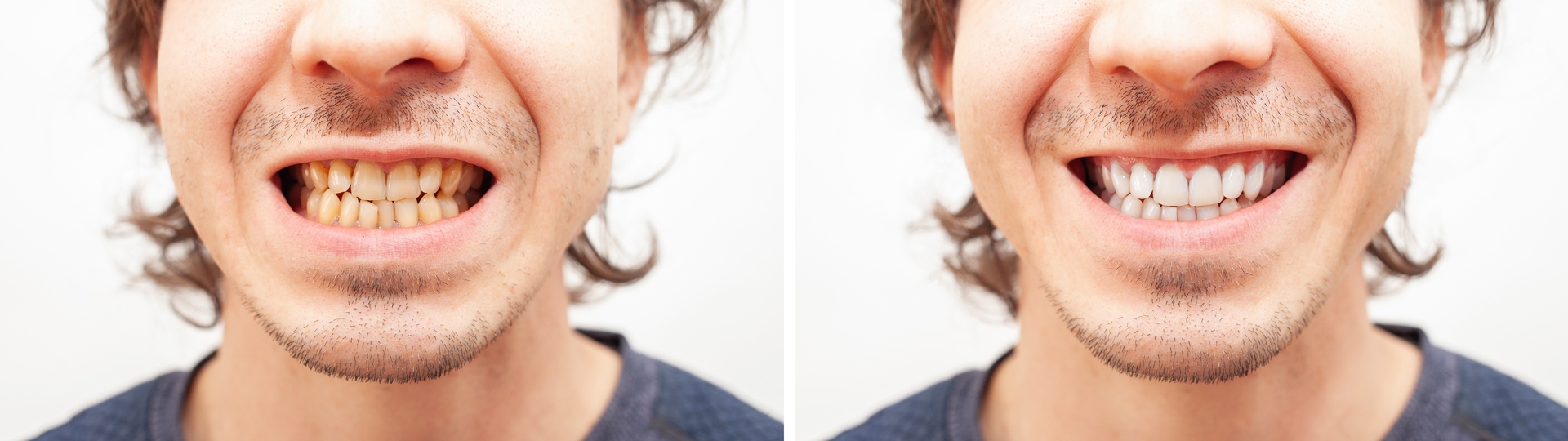 El antes y después de una persona con alineadores dentales.