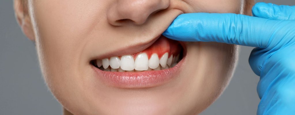 Las encías inflamadas son una de las señales más comunes para indicarte que algo no anda bien en tu salud bucal.