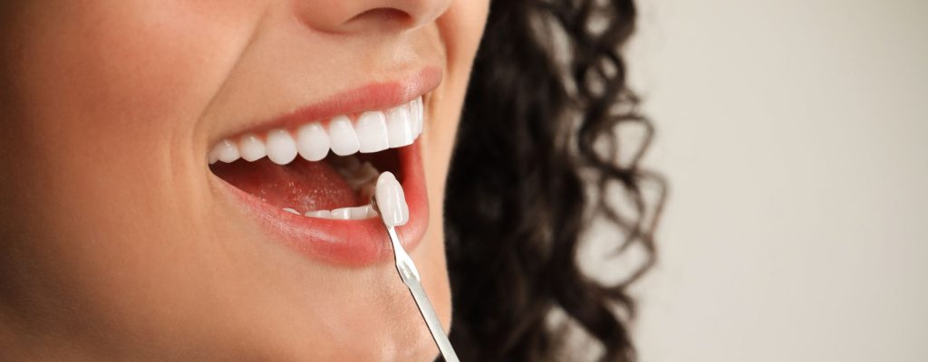 Conoce los principales tipos de carillas dentales que puedes encontrar en el rubro dental, tanto sus ventajas y desventajas.