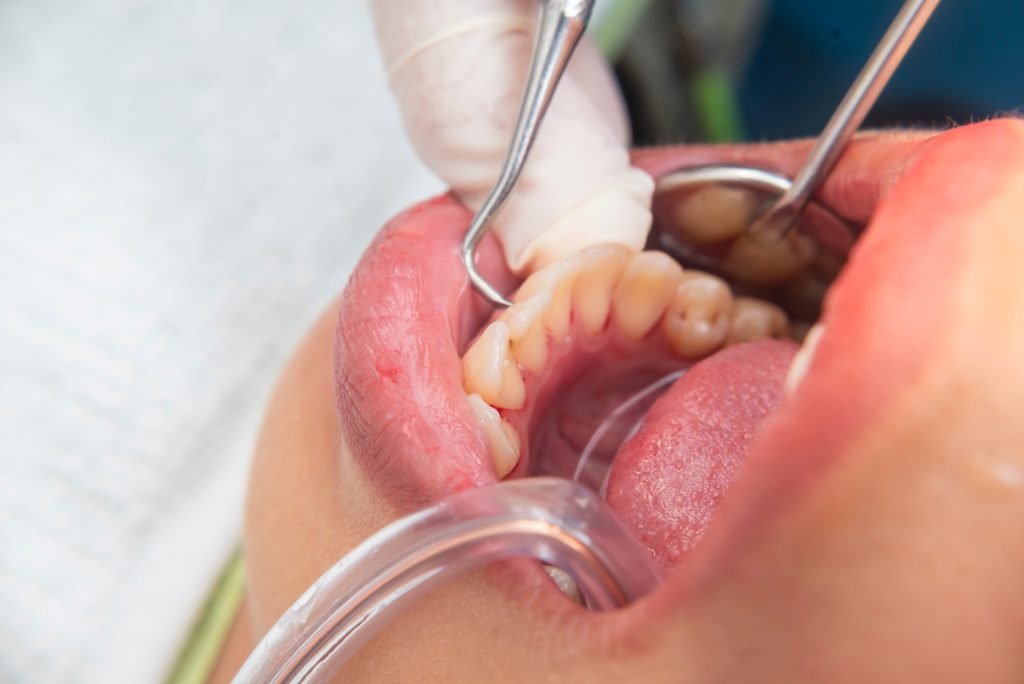 Destartraje dental: ¿Qué es y cuándo se recomienda?