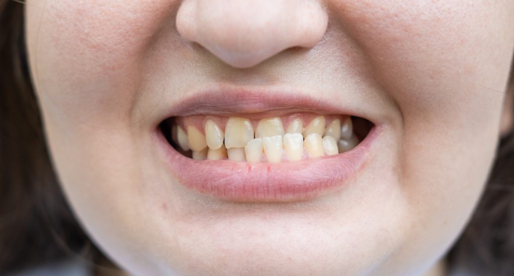 Maloclusiones dentales: ¿Qué son y cuáles son sus causas?